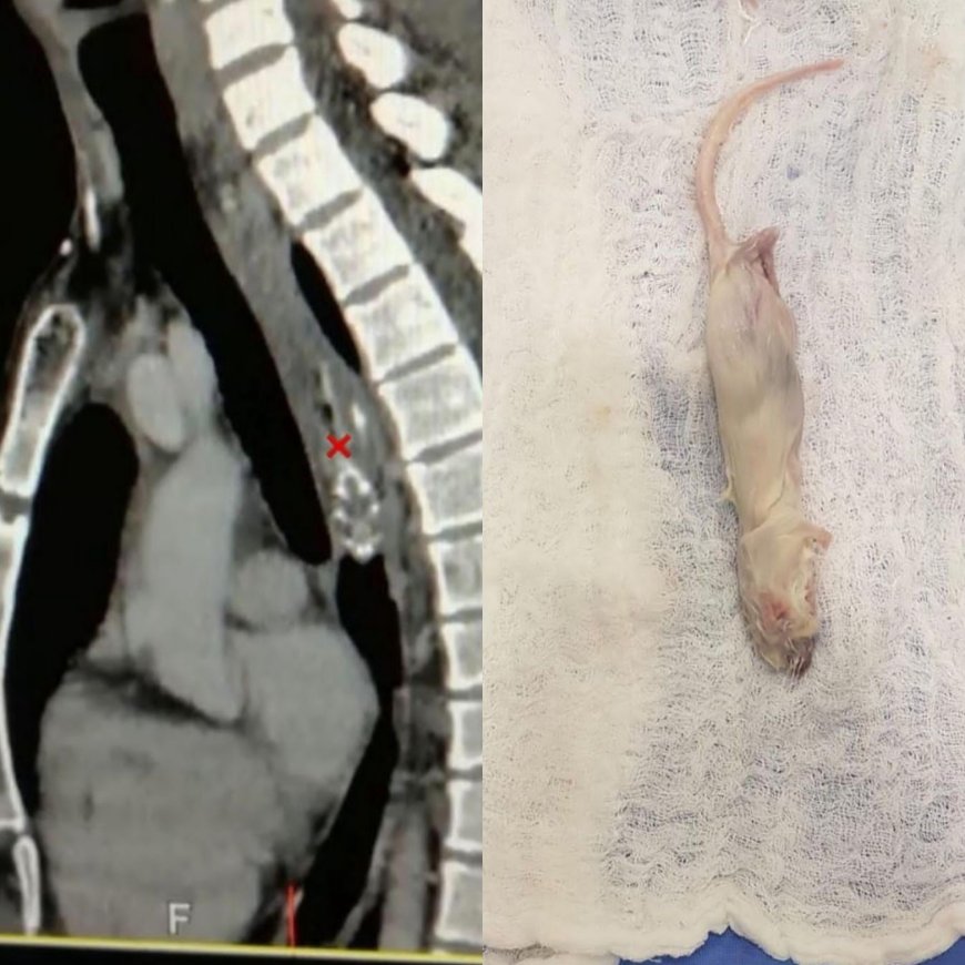 Whole mouse dug out of patient's esophagus during surgery